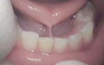 Dính thắng lưỡi là gì ?