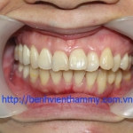 Trám răng Composite-Tetric-N-Ceram A3-DentinA3,5