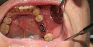 Cấy ghép implant 2