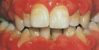 QUÁ TRIỂN NƯỚU DO PHENYTOIN