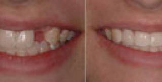 Chịu lực tức thì trên Implant là gì?