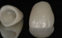 HỆ THỐNG SỨ E.MAX TẠI AVA