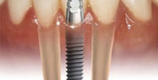 Tại sao cấy ghép răng(implant) là phương pháp ưu tiên? 