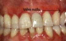 Viêm nướu răng ở trẻ em