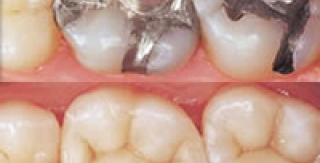 Trám Amalgam