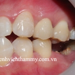 Răng sứ đẹp tự nhiên