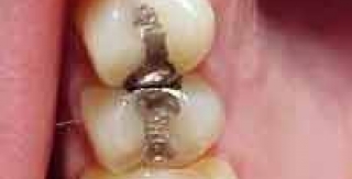 Trên phương diện đạo đức,Hiệp Hội Nha Khoa Mỹ đã phát biểu như thế nào về việc lấy đi những miếng trám Amalgam để phòng ngừa nhiễm độc thủy ngân?