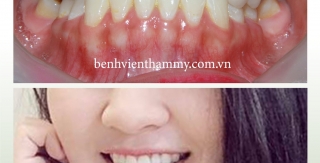 Niềng răng móm – Giải pháp hiệu quả cho khớp cắn lệch