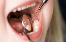 Làm sao phát hiện được sâu răng? 