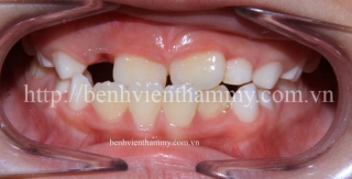 Chỉnh hình răng mọc lệch, thưa sớm cho trẻ