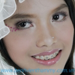 Chỉnh nha thẩm mỹ