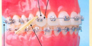 Phụ huynh và trẻ -Sự cần thiết trong điều trị chỉnh nha thành công