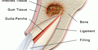 Tại sao khi lấy tủy xong ta phải bít ống tủy lại (Root canal obturation)? 