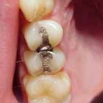 Trên phương diện đạo đức,Hiệp Hội Nha Khoa Mỹ đã phát biểu như thế nào về việc lấy đi những miếng trám Amalgam để phòng ngừa nhiễm độc thủy ngân?