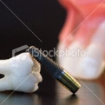 CÁC YẾU TỐ QUYẾT ĐỊNH ĐỐI VỚI CHỊU LỰC IMPLANT TỨC THÌ
