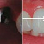 SƠ LƯỢC VỀ VIỆC CẤY GHÉP XƯƠNG TRONG PHẪU THUẬT IMPLANT