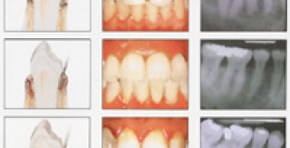 Các yếu tố phụ gây nha chu viêm: 