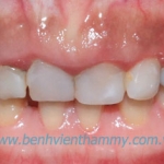 Phục hình răng sứ Cercon Smart – Dentsfly