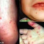 Kết quả của một số nghiên cứu về bệnh tay chân miệng 