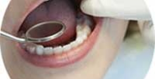 Bệnh nha chu có thể làm mất răng