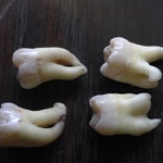 Đi nhổ răng suýt mất cả tay