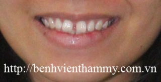 Chỉnh hình răng thẩm mỹ điều trị răng thưa