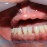 Phục hình trên implant (hàm phủ)