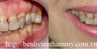 Cải thiện nụ cười với răng nhiễm tertracyclin với Mặt dán sứ