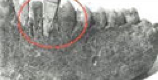 Lịch sử về cấy ghép răng (implant) 