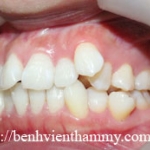 Chỉnh hình răng thẩm mỹ điều trị răng chen chúc với mắc cài kim loại 1