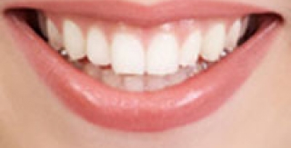 Răng sứ Zirconia là gì ? 