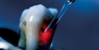 Ứng Dụng Của Laser Trong Trám Răng Thẩm Mỹ