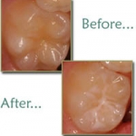 Trám bít hố rãnh bằng sealant