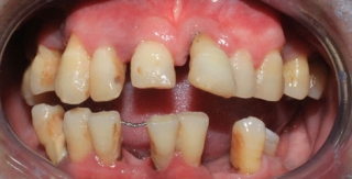 Phục hình toàn hàm 4