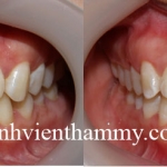 Trám răng Composite-Tetric-N-Ceram -Nano-Ivoclar Vivadent-Thụy sỹ
