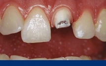 Thời gian làm răng sứ trong bao lâu? 