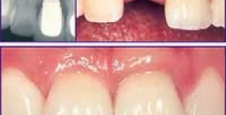 Cấy Ghép Implant Có Răng Giả Sớm 