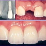 Răng sâu bể nhiều, phải bảo tồn bằng cách nào? 