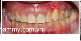 Chỉnh hình răng thẩm mỹ điều trị răng thưa do răng nanh mọc ngầm với mắc cài kim loại
