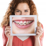 Chỉnh răng thẩm mỹ răng hô kèm cắn sâu