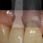 LỊCH SỬ PHÁT TRIỂN IMPLANT TỨC THÌ