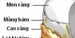 Chế Độ Ăn Và Mảng Bám Vi Khuẩn Gây Bệnh Nha Chu Và Sâu Răng