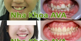 Niềng răng mọc chen chúc ở trẻ em