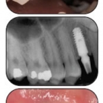 Cấy ghép Implant là gì ?