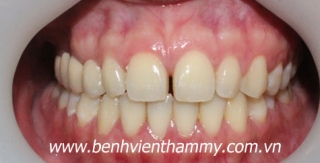 Chỉnh nha thẩm mỹ 1