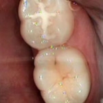 Liệu các chất trám bít hố rãnh(sealants) có hiệu quả thật sự ?