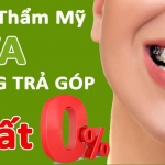 Niềng răng trả góp lãi suất 0% Quận 10, TpHCM