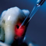 Ứng Dụng Của Laser Trong Trám Răng Thẩm Mỹ