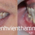 Răng sứ Emax Zircad - Ivoclar Vivadent - Thụy Sỹ 24