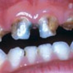 Trẻ Em Bị Sâu Răng Tăng Cao Nguy Cơ Mập Phì